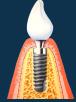 Implantes Dentales en Ciudad de México (Col. Del Valle México) - Horario de apertura